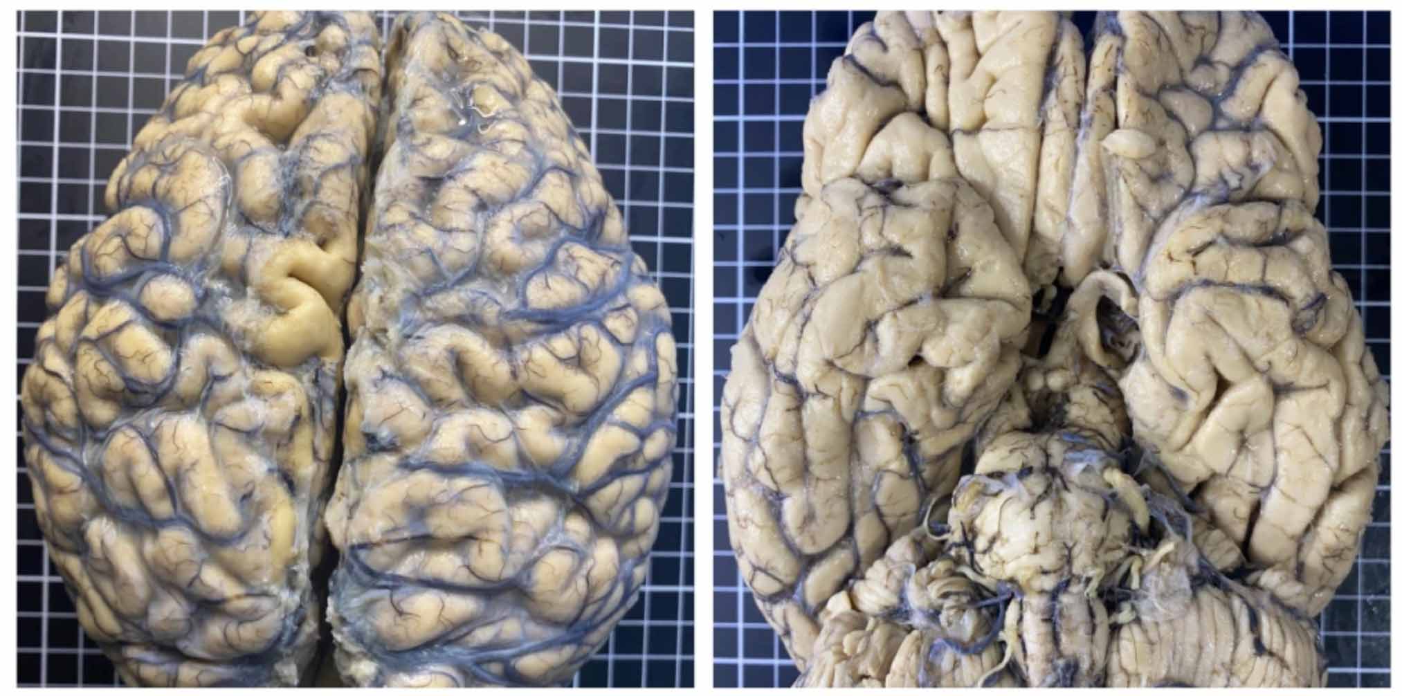 National Dementia BioBank